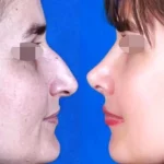 جراحی بینی امسال چند درمی‌آید؟